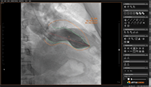 Análisis ventricular izquierdo