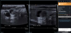 analisis ecografia mamaria