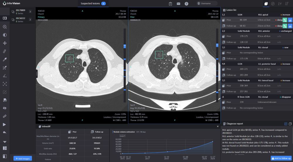 ia analisis cancer pulmon