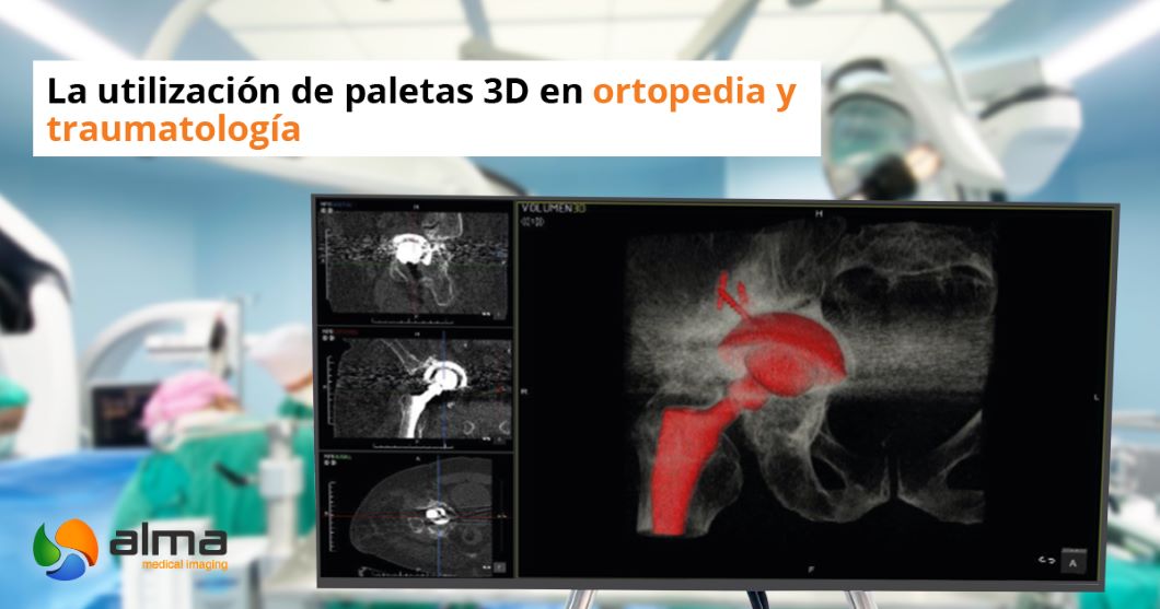 paletas 3d ortopedia traumatología