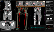 vascular analisis calcificaciones