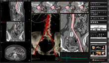 vascular reconstruccion mpr