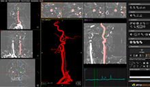 vascular segmentacion automatica