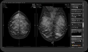 visor dicom mamografias
